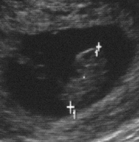 larger cashew sonogram