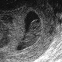 larger pistachio sonogram